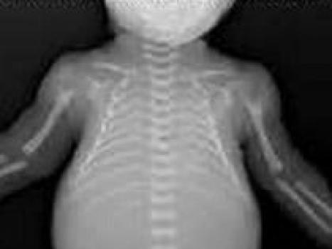Uşaqlarda axondroplaziya - xəstəliyin genetikası və simptomları
