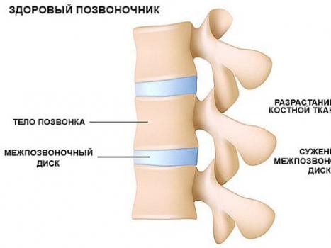 Diagnose av osteokondrose: hovedårsaker, komplikasjoner og behandling Osteokondrose i ryggraden