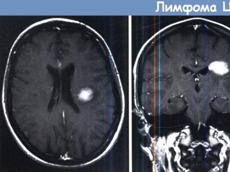 Primary brain lymphoma due to HIV infection